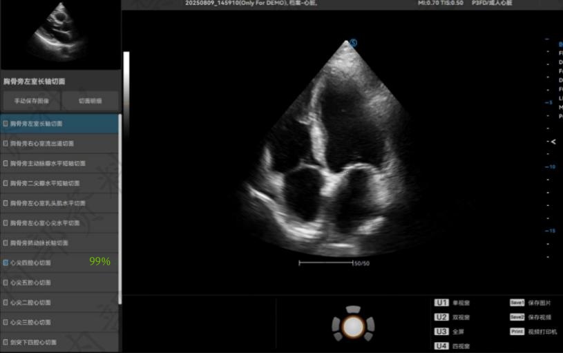 心脏心尖部四腔心标准切面自动识别.jpg